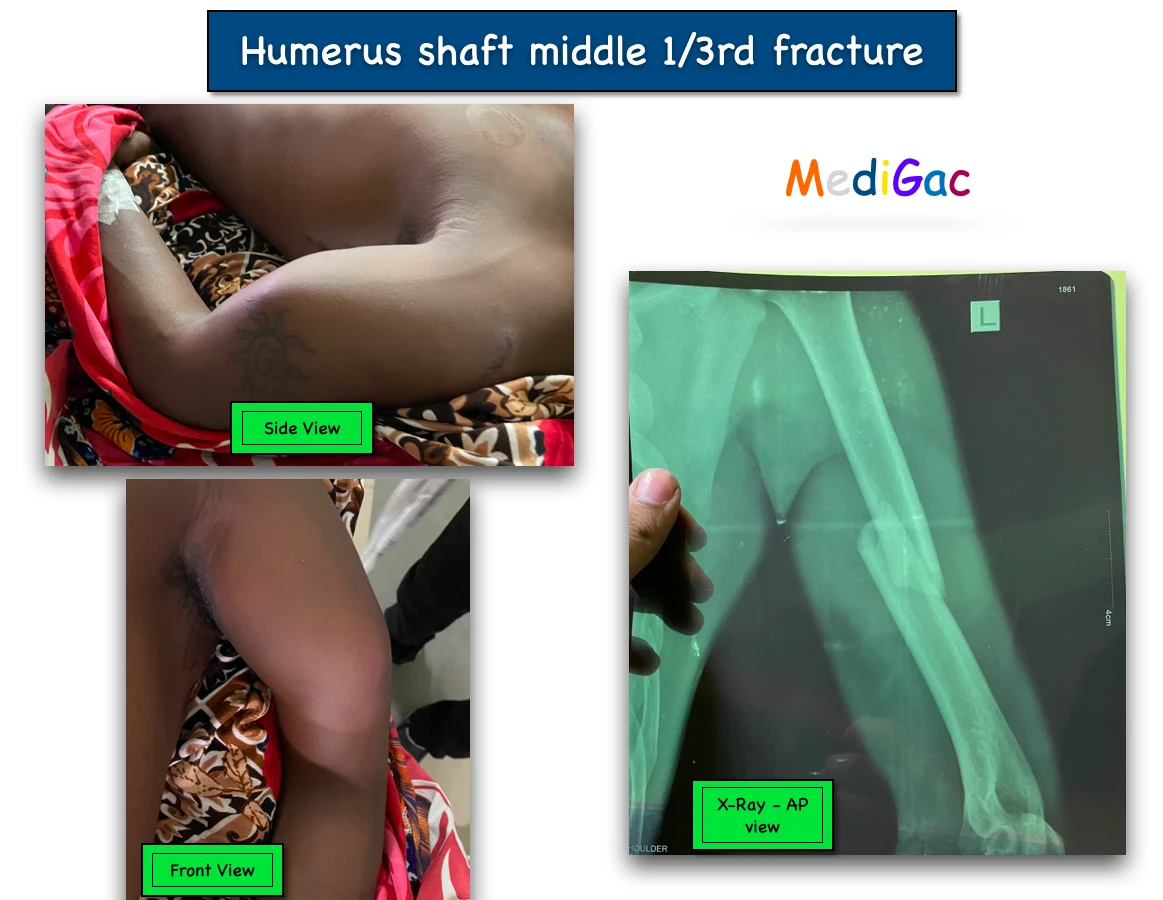 Humerus shaft fracture in middle 1/3rd